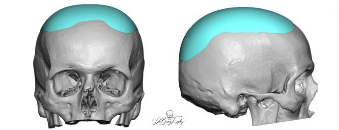 Small Heightening Skull Implant design Dr Barry Eppley