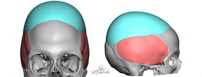 Large Heightening Custom Skull Implant design for Flat Head by Dr Barry Eppley
