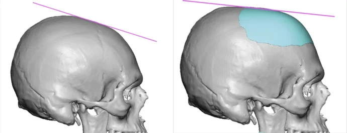 3d rendering of custom skull implant for sloped upper forehead
