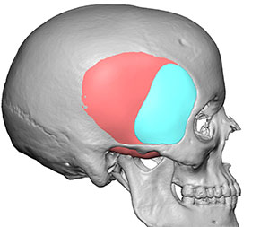 3d skull rendition with custom temporal implant by Dr. Barry L. Eppley